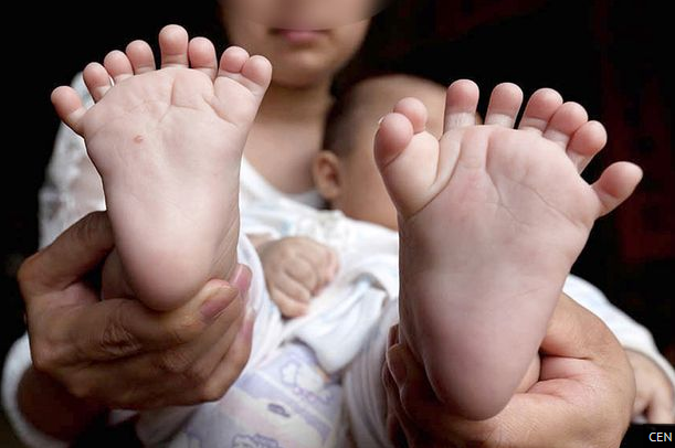 baby-born-with-15-fingers-and-16-toes-undergoes-surgery